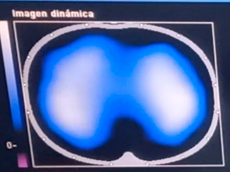 Imágenes de tomografía que se toman para analizar el desempeño de la fisioterapia con el inventivo Ubicu